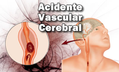 acidente vascular cerebral